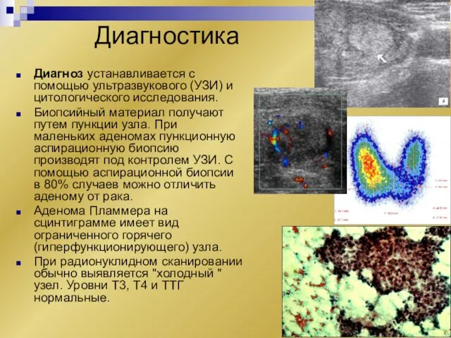 Диагностика Диагноз устанавливается с помощью ультразвукового (УЗИ) и цитологического исследования.