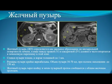 Желчный пузырь Желчный пузырь (ЖП) определяется как овальное образование на