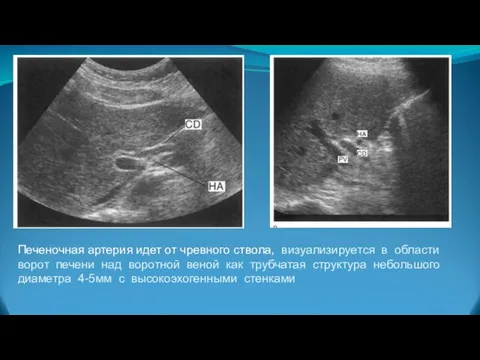 Печеночная артерия идет от чревного ствола, визуализируется в области ворот