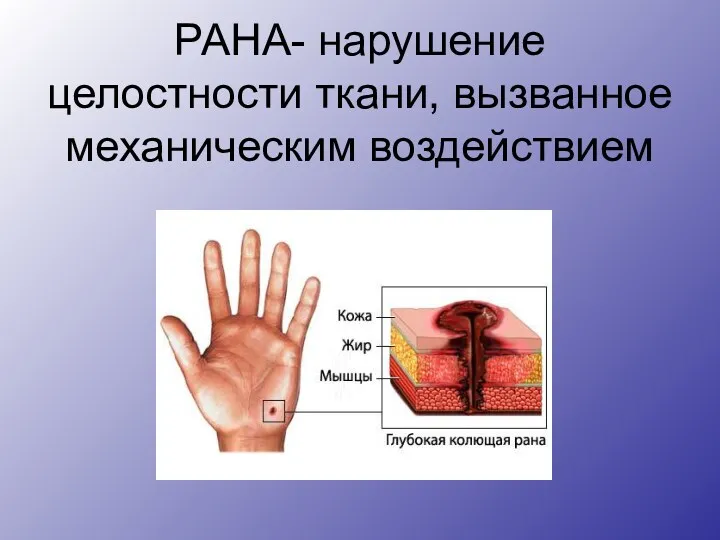 РАНА- нарушение целостности ткани, вызванное механическим воздействием