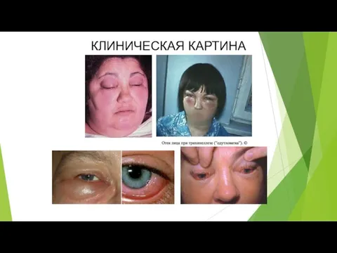 КЛИНИЧЕСКАЯ КАРТИНА