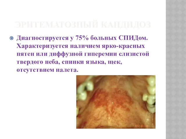 ЭРИТЕМАТОЗНЫЙ КАНДИДОЗ Диагностируется у 75% больных СПИДом. Характеризуется наличием ярко-красных