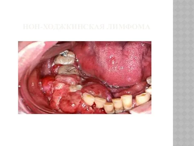 НОН-ХОДЖКИНСКАЯ ЛИМФОМА