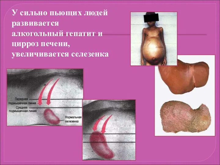 У сильно пьющих людей развивается алкогольный гепатит и цирроз печени, увеличивается селезенка