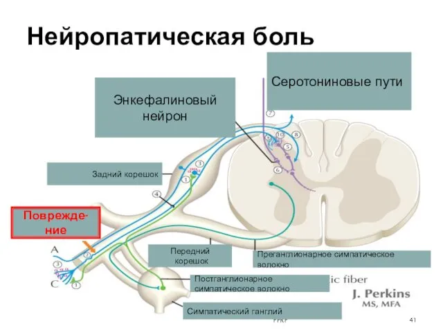 Нейропатическая боль PPRP Поврежде-ние Задний корешок Передний корешок Энкефалиновый нейрон