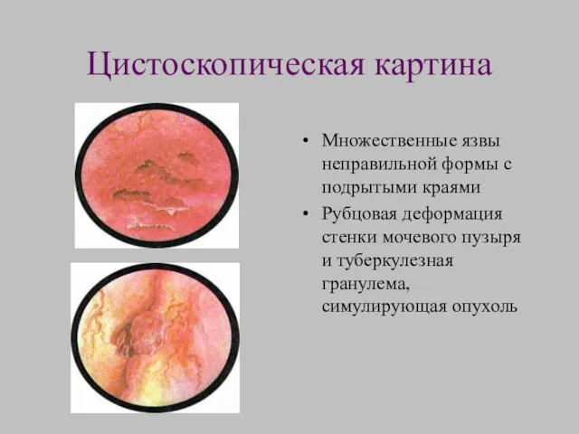 Цистоскопическая картина Множественные язвы неправильной формы с подрытыми краями Рубцовая