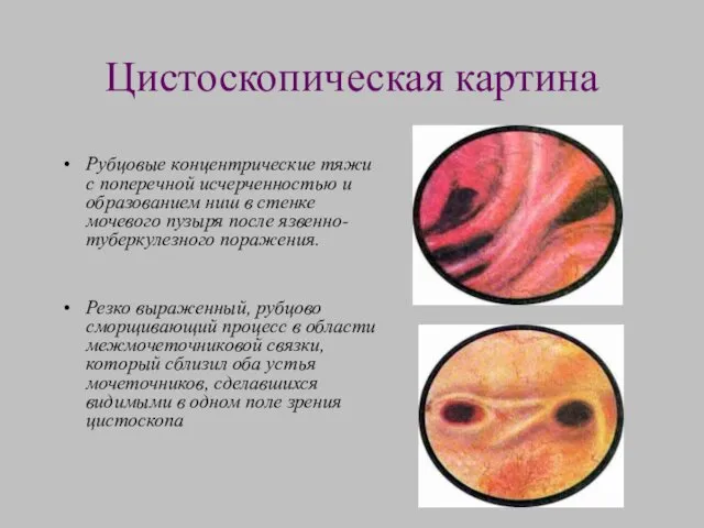 Цистоскопическая картина Рубцовые концентрические тяжи с поперечной исчерченностью и образованием