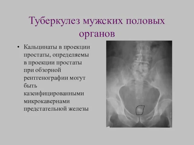 Туберкулез мужских половых органов Кальцинаты в проекции простаты, определяемы в