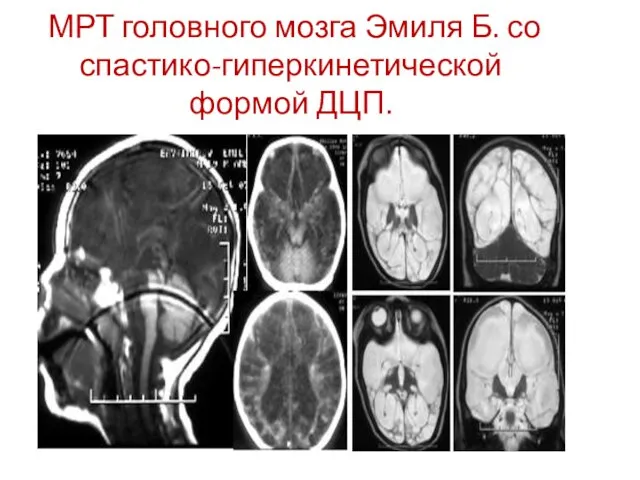 МРТ головного мозга Эмиля Б. со спастико-гиперкинетической формой ДЦП.