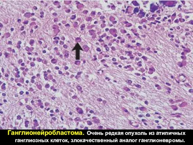 Ганглионейробластома. Очень редкая опухоль из атипичных ганглиозных клеток, злокачественный аналог ганглионевромы.
