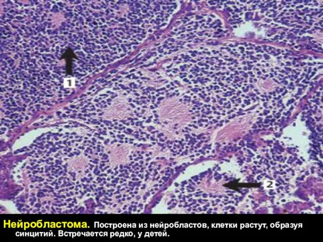 Нейробластома. Построена из нейробластов, клетки растут, образуя синцитий. Встречается редко, у детей.