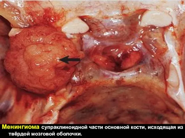 Менингиома супраклиноидной части основной кости, исходящая из твёрдой мозговой оболочки.
