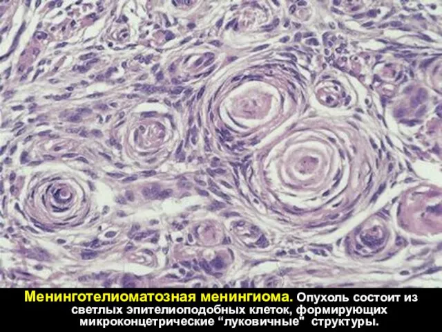 Менинготелиоматозная менингиома. Опухоль состоит из светлых эпителиоподобных клеток, формирующих микроконцетрические “луковичные" структуры.