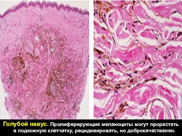 Голубой невус. Пролиферирующие меланоциты могут прорастать в подкожную клетчатку, рецидивировать, но доброкачественен.