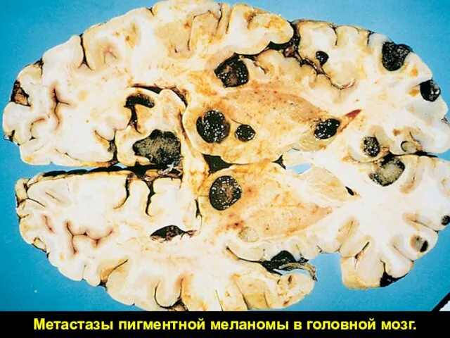 Метастазы пигментной меланомы в головной мозг.