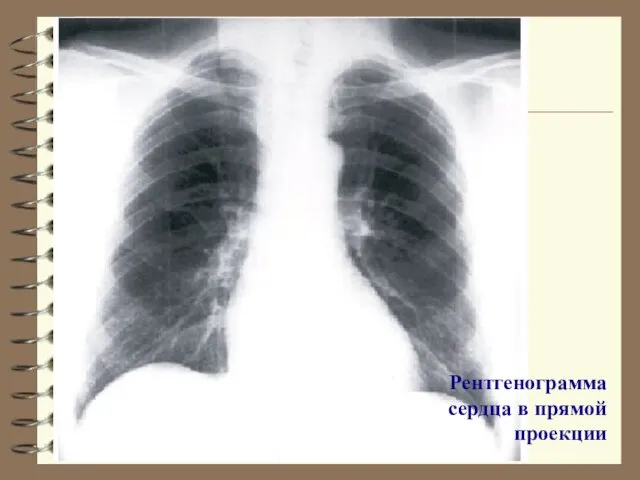 Рентгенограмма сердца в прямой проекции