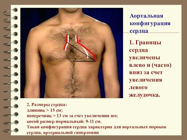 2. Размеры сердца: длинник > 15 см; поперечник > 13