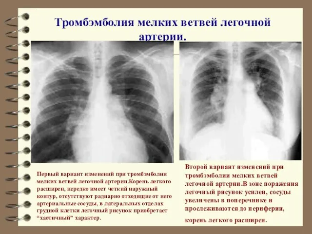 Тромбэмболия мелких ветвей легочной артерии. Первый вариант изменений при тромбэмболии