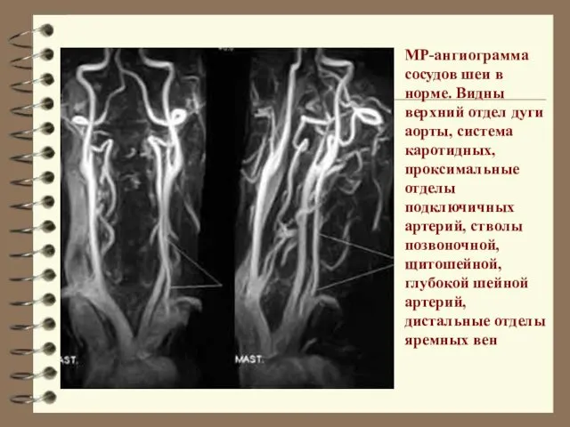 МР-ангиограмма сосудов шеи в норме. Видны верхний отдел дуги аорты,