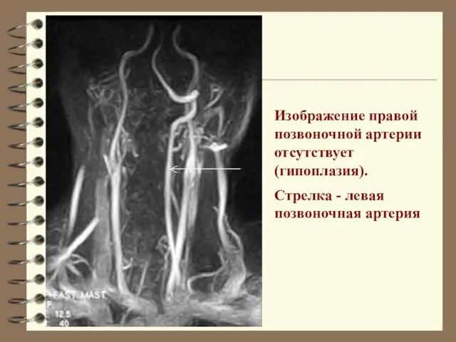 Изображение правой позвоночной артерии отсутствует (гипоплазия). Стрелка - левая позвоночная артерия