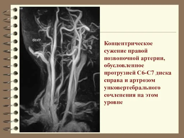 Концентрическое сужение правой позвоночной артерии, обусловленное протрузией С6-С7 диска справа
