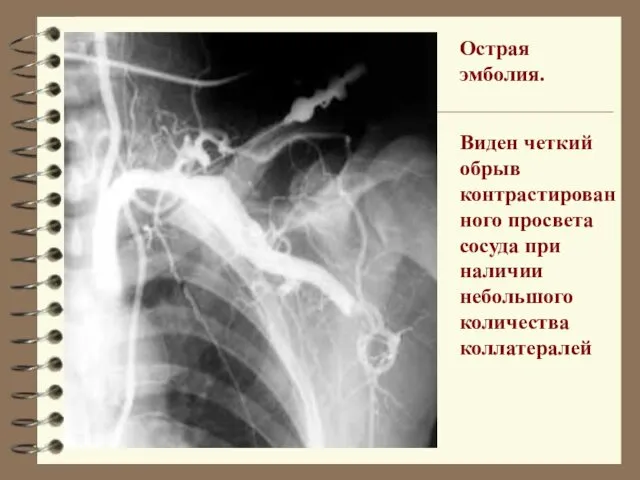 Острая эмболия. Виден четкий обрыв контрастированного просвета сосуда при наличии небольшого количества коллатералей