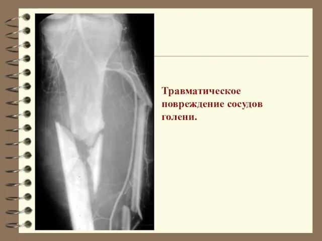 Травматическое повреждение сосудов голени.