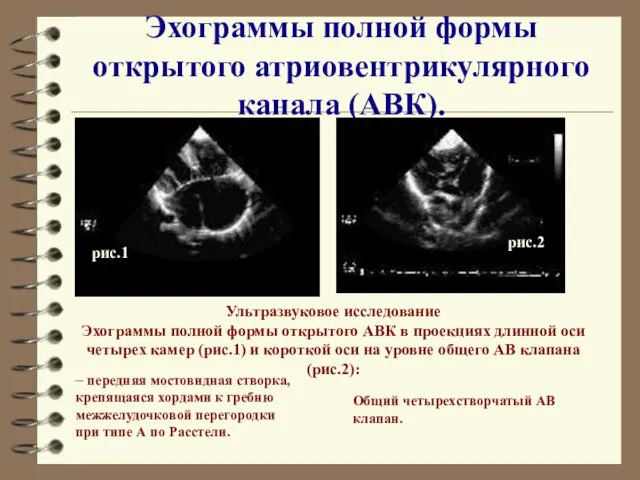 Эхограммы полной формы открытого атриовентрикулярного канала (АВК). Ультразвуковое исследование Эхограммы