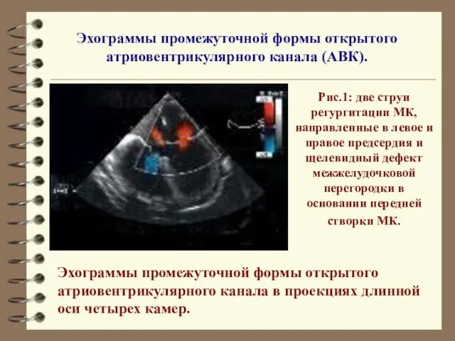 Эхограммы промежуточной формы открытого атриовентрикулярного канала (АВК). Эхограммы промежуточной формы