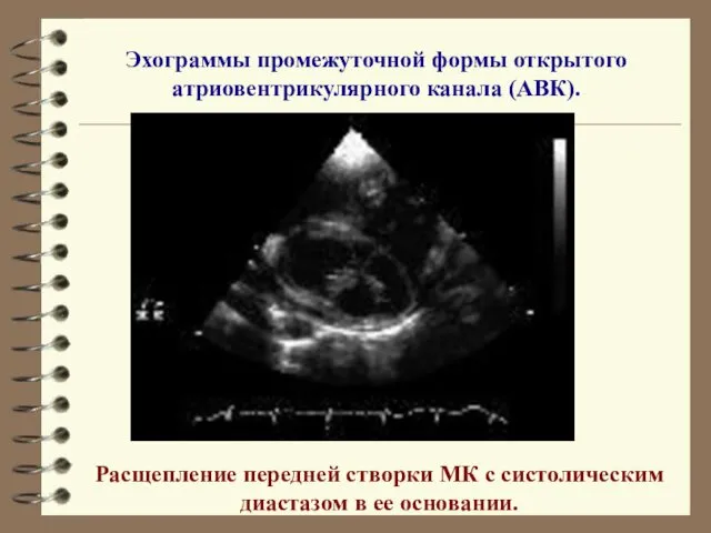 Эхограммы промежуточной формы открытого атриовентрикулярного канала (АВК). Расщепление передней створки