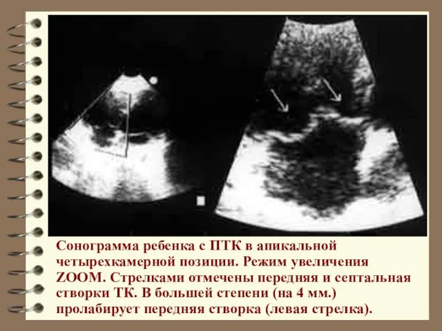 Сонограмма ребенка с ПТК в апикальной четырехкамерной позиции. Режим увеличения