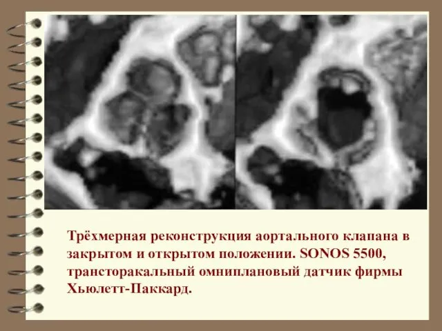 Трёхмерная реконструкция аортального клапана в закрытом и открытом положении. SONOS 5500, трансторакальный омниплановый датчик фирмы Хьюлетт-Паккард.