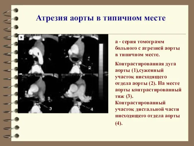 Атрезия аорты в типичном месте а - серия томограмм больного