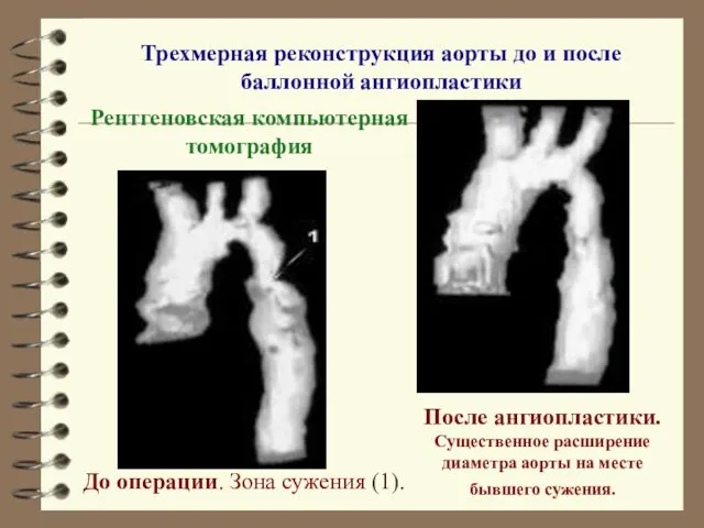 Трехмерная реконструкция аорты до и после баллонной ангиопластики До операции.