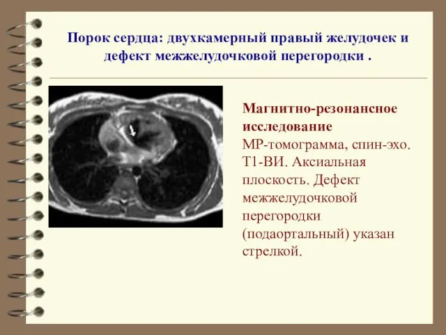 Порок сердца: двухкамерный правый желудочек и дефект межжелудочковой перегородки .