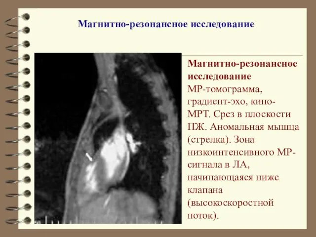 Магнитно-резонансное исследование МР-томограмма, градиент-эхо, кино-МРТ. Срез в плоскости ПЖ. Аномальная