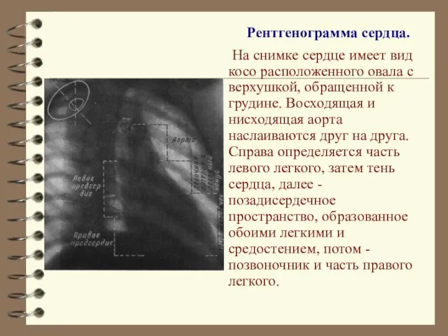 Рентгенограмма сердца. На снимке сердце имеет вид косо расположенного овала