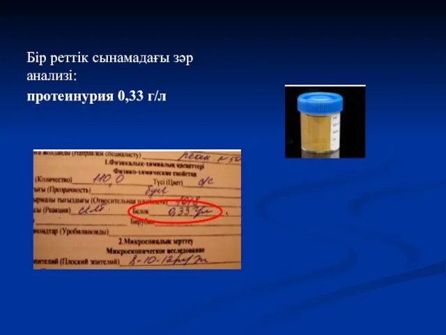 Бір реттік сынамадағы зәр анализі: протеинурия 0,33 г/л