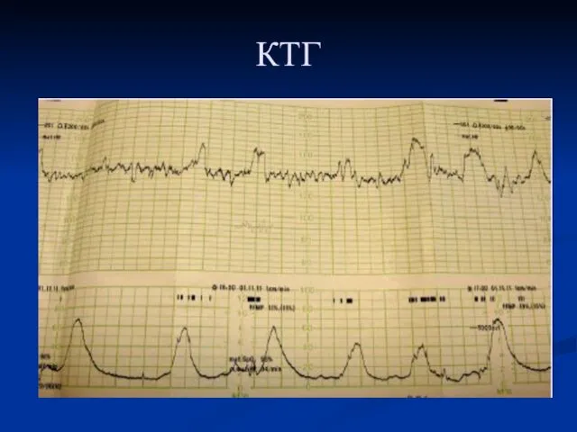 КТГ