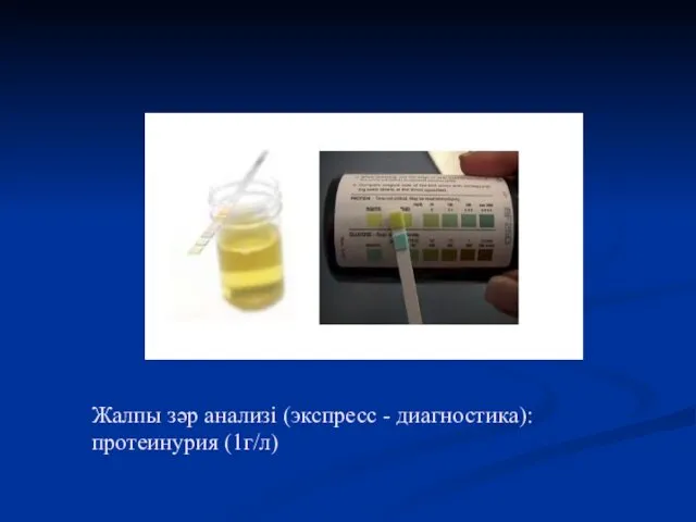 Жалпы зәр анализі (экспресс - диагностика): протеинурия (1г/л)