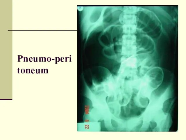 Pneumo-peritoneum