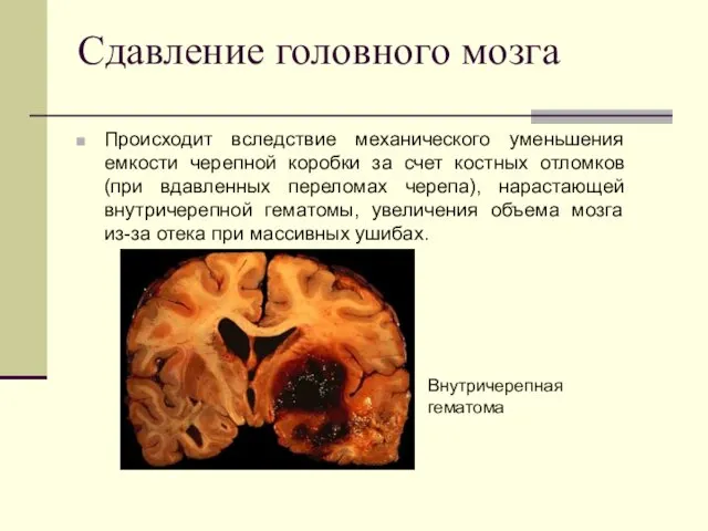 Сдавление головного мозга Происходит вследствие механического уменьшения емкости черепной коробки