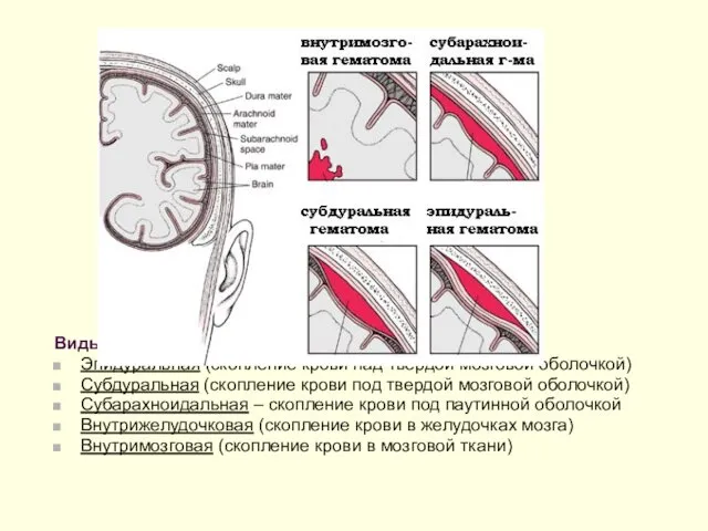 Виды гематом: Эпидуральная (скопление крови над твердой мозговой оболочкой) Субдуральная