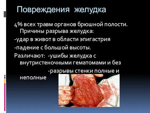 Повреждения желудка 4% всех травм органов брюшной полости.Причины разрыва желудка: -удар в живот