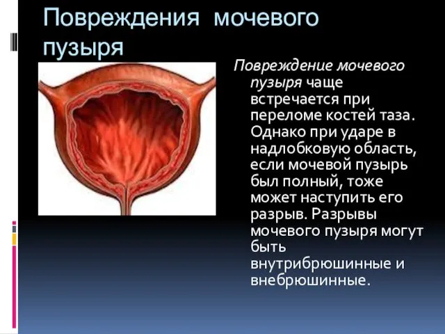 Повреждения мочевого пузыря Повреждение мочевого пузыря чаще встречается при переломе