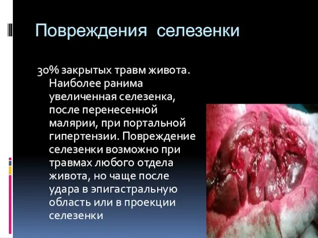 Повреждения селезенки 30% закрытых травм живота. Наиболее ранима увеличенная селезенка,после