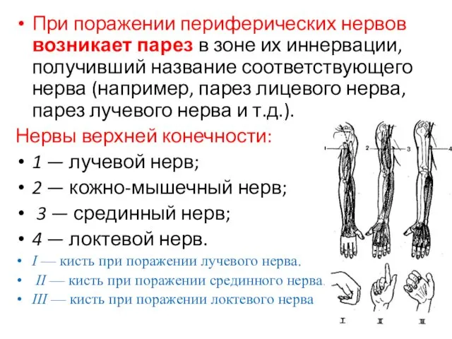 При поражении периферических нервов возникает парез в зоне их иннервации,