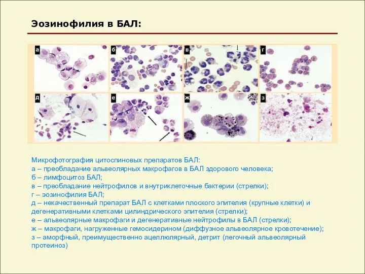 Эозинофилия в БАЛ: Микрофотография цитоспиновых препаратов БАЛ: а – преобладание