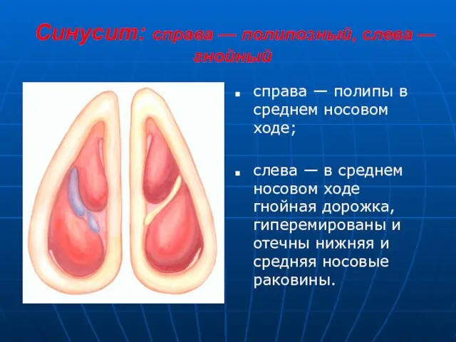 Синусит: справа — полипозный, слева — гнойный справа — полипы