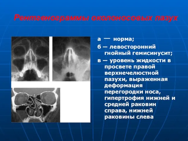 Рентгенограммы околоносовых пазух а — норма; б — левосторонний гнойный